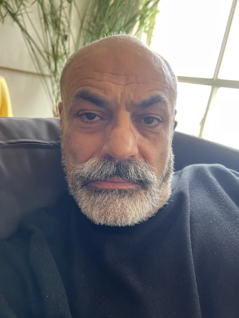 Original photo before Jawline Filler