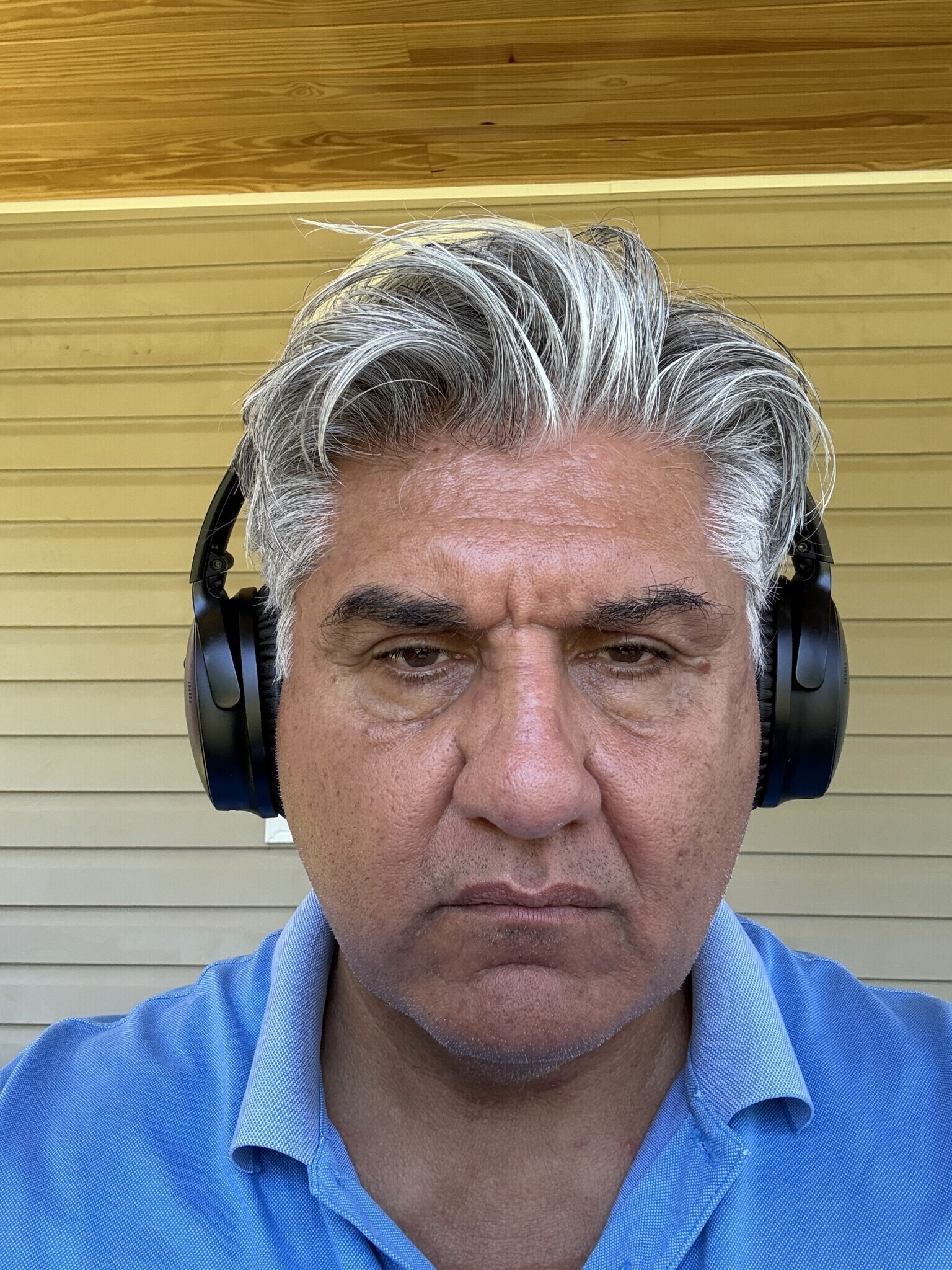 Original photo before Botox (Glabella / 11s)